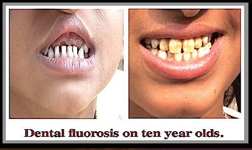 fluorosis-10-year-olds-india-f