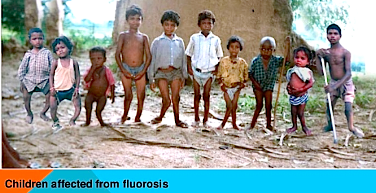 children-affected-from-fluorosis