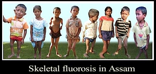 sketetal-fluorosis-in-assam
