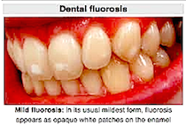 dental-fluorsis-f-f