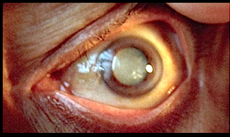 eye-cataract-f