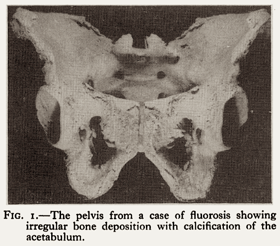 fluorosis-of-pelvis-1962